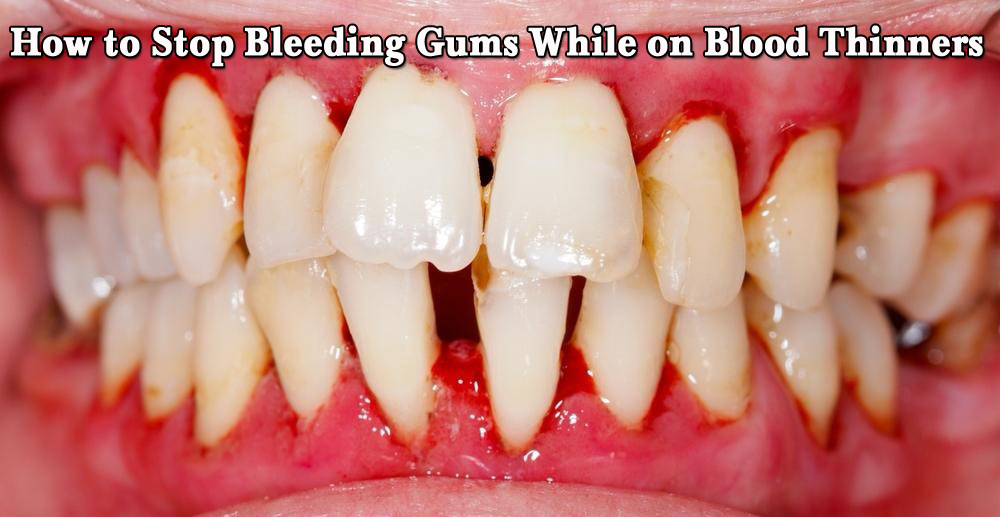 How to Stop Bleeding Gums While on Blood Thinners