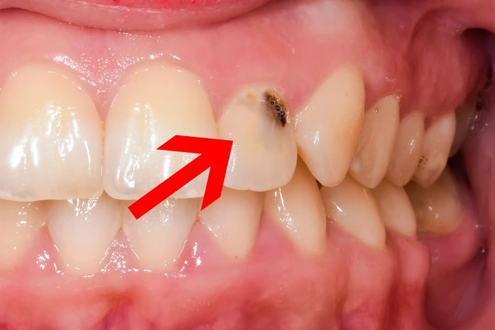 Front Tooth Cavity