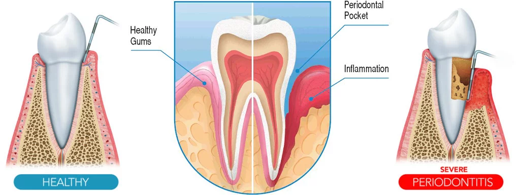 Gum Disease and Periodontal Disease