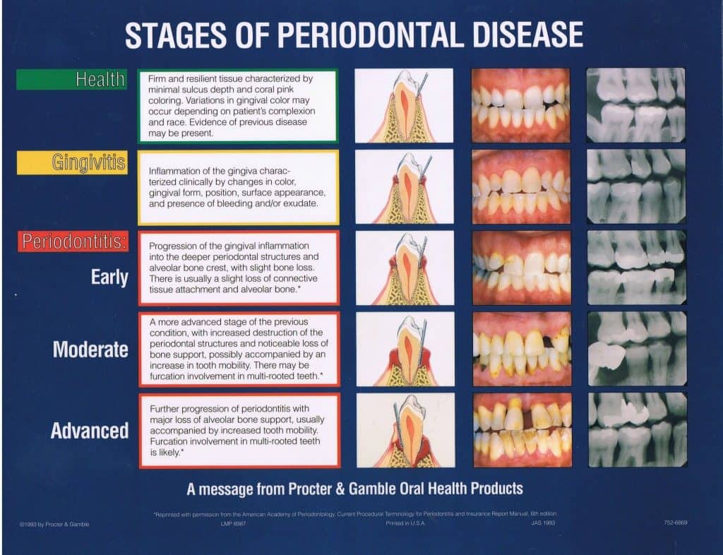 Gum Disease and Periodontal Disease