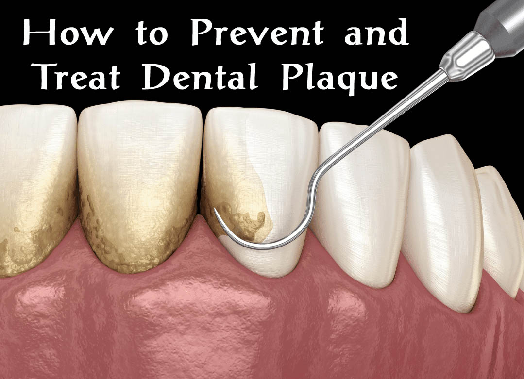 Dental Plaque