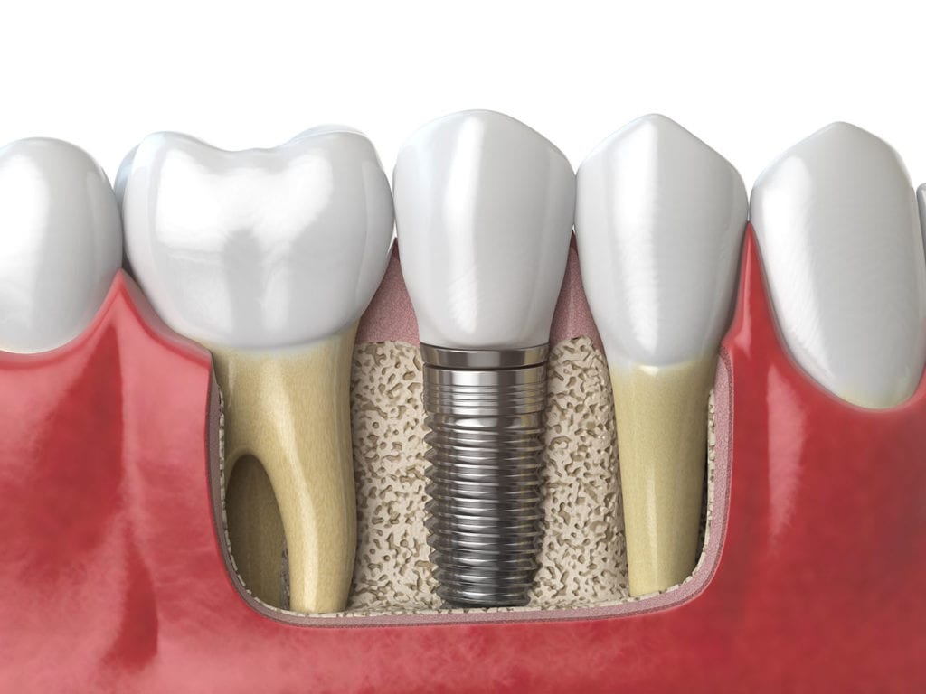 Are Dental Implants Painful