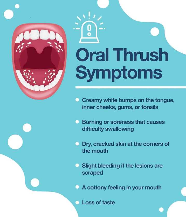Oral Thrush Causes Symptoms And Treatment Options