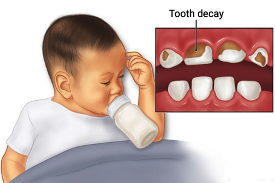 Baby Bottle Tooth Decay