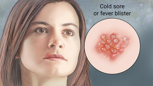 Cold Sores