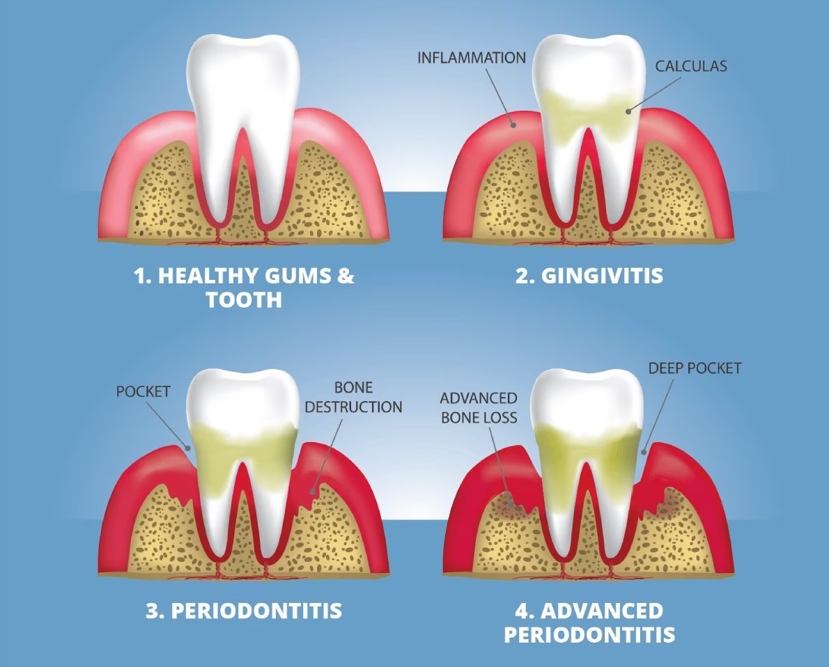 Gingivitis: A Complete Guide to Preventing and Treating Gum Disease in 2023